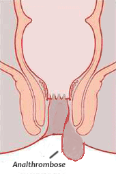 Thrombose anal