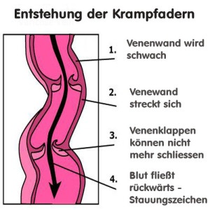 anatomie-varikose-500