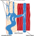 krampfadern2