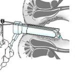 barron-ligation