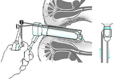 Analvenenthrombose unterschied hämorrhoiden Analthrombose: Symptome