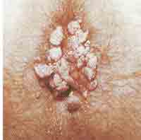 condylomen-200