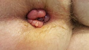 Hpv rectal warts - Hpv bumps treatment - Cancer in rectal stump