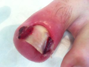 ingrown-toenail or also unguis incarnatus