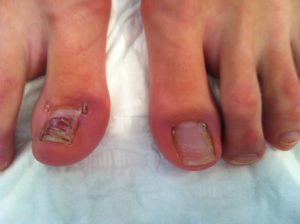 toe with infection 