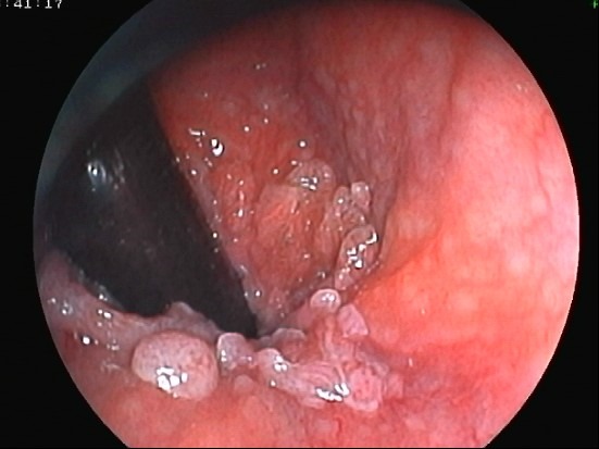 Feigwarzen condylomata rectal 01
