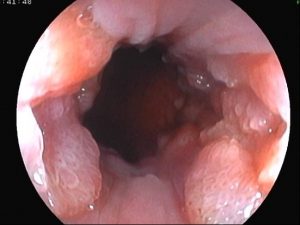 Gyöngy és condyloma. Szűzhártya vagy condyloma - Javallott-e elmennem egy hpv szűrésre?