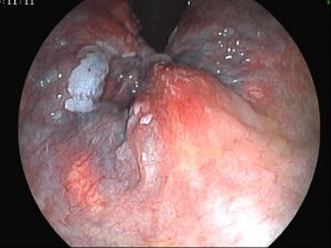 condylomata rectal 04