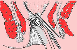 Unterschied hämorrhoiden analvenenthrombose. 